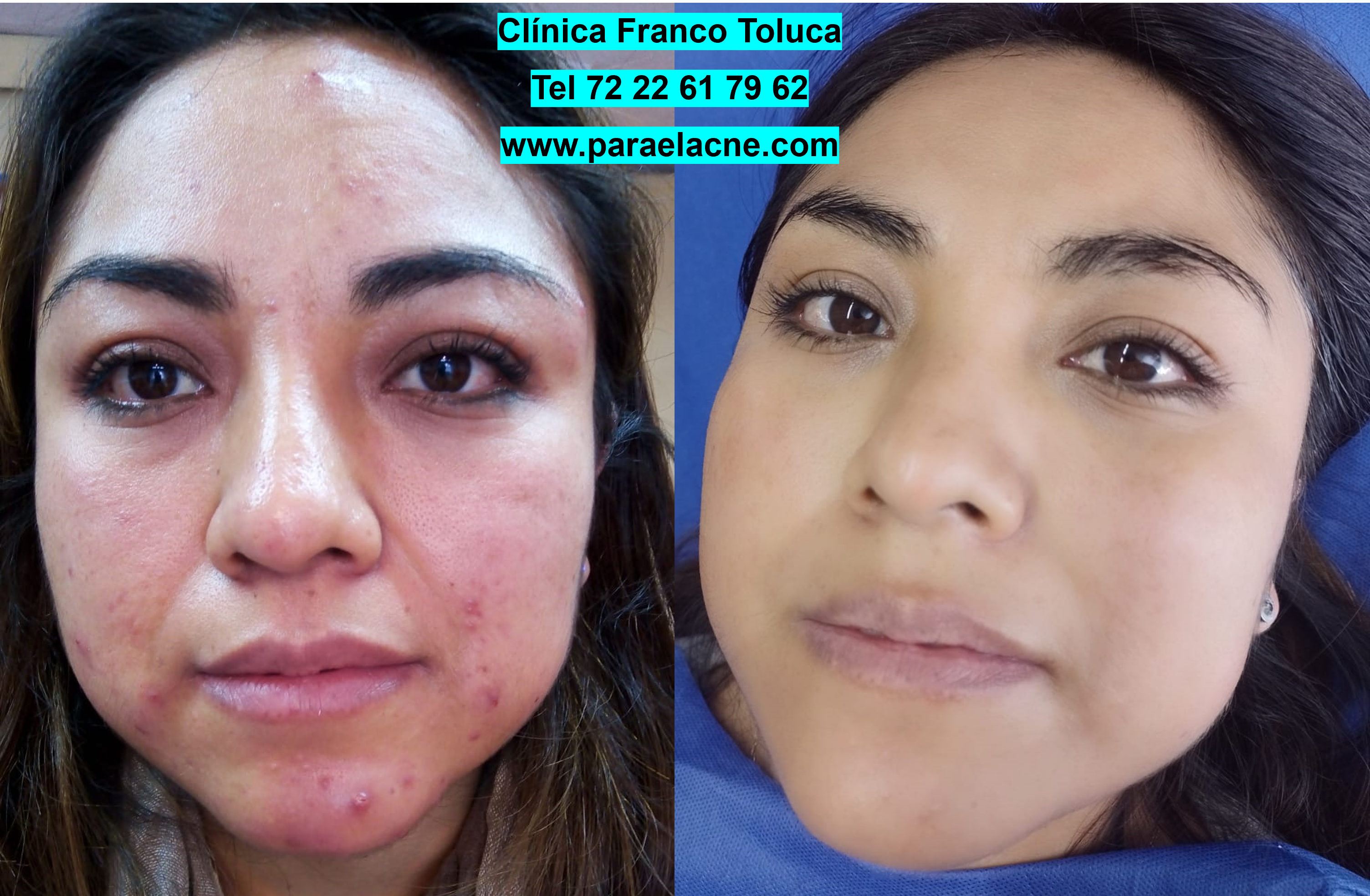 Eliminación de cicatrices de acné en Metepec: caso real de éxito.