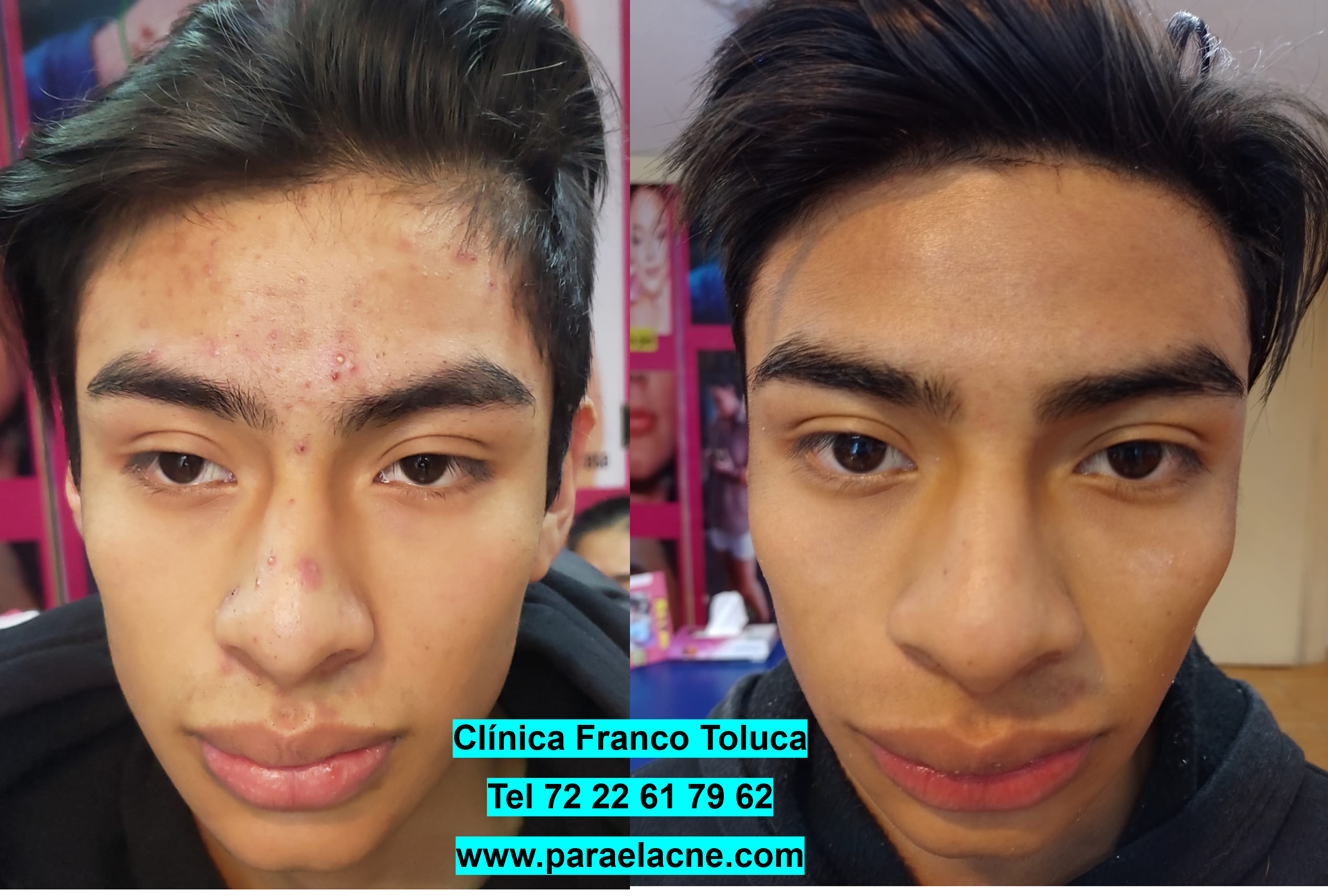 Eliminación de cicatrices de acné en Metepec: caso real de éxito.