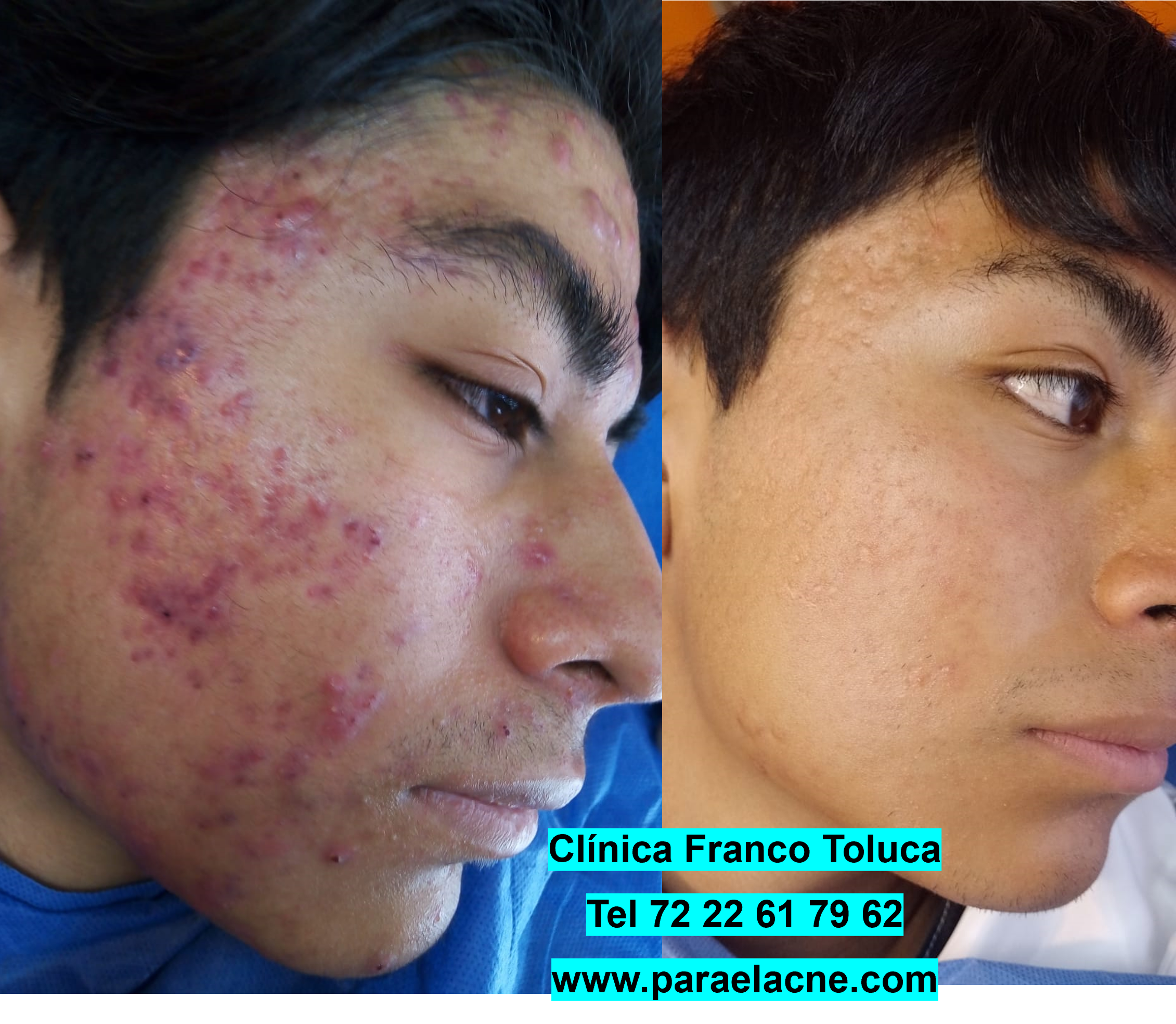antes y despues paciente de acné en Metepec