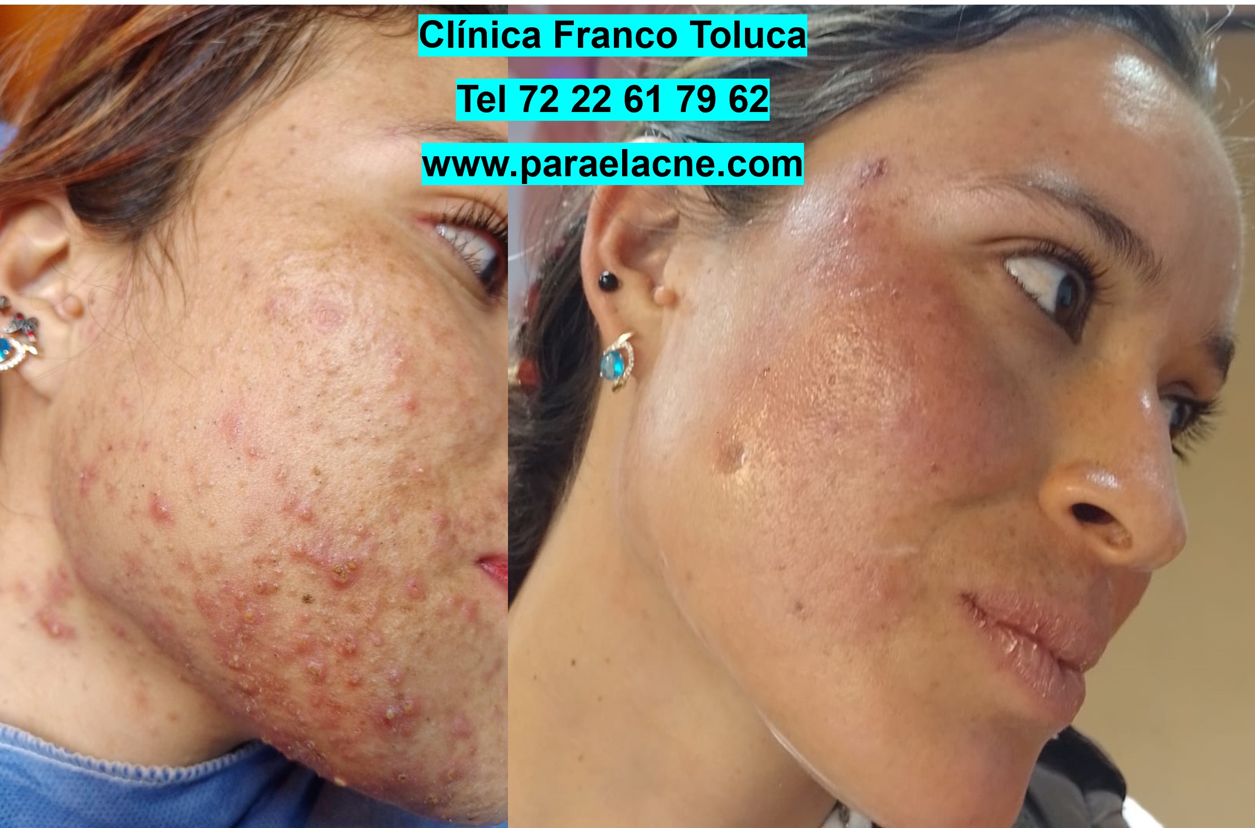 Resultado de tratamiento para cicatrices de acné en Metepec