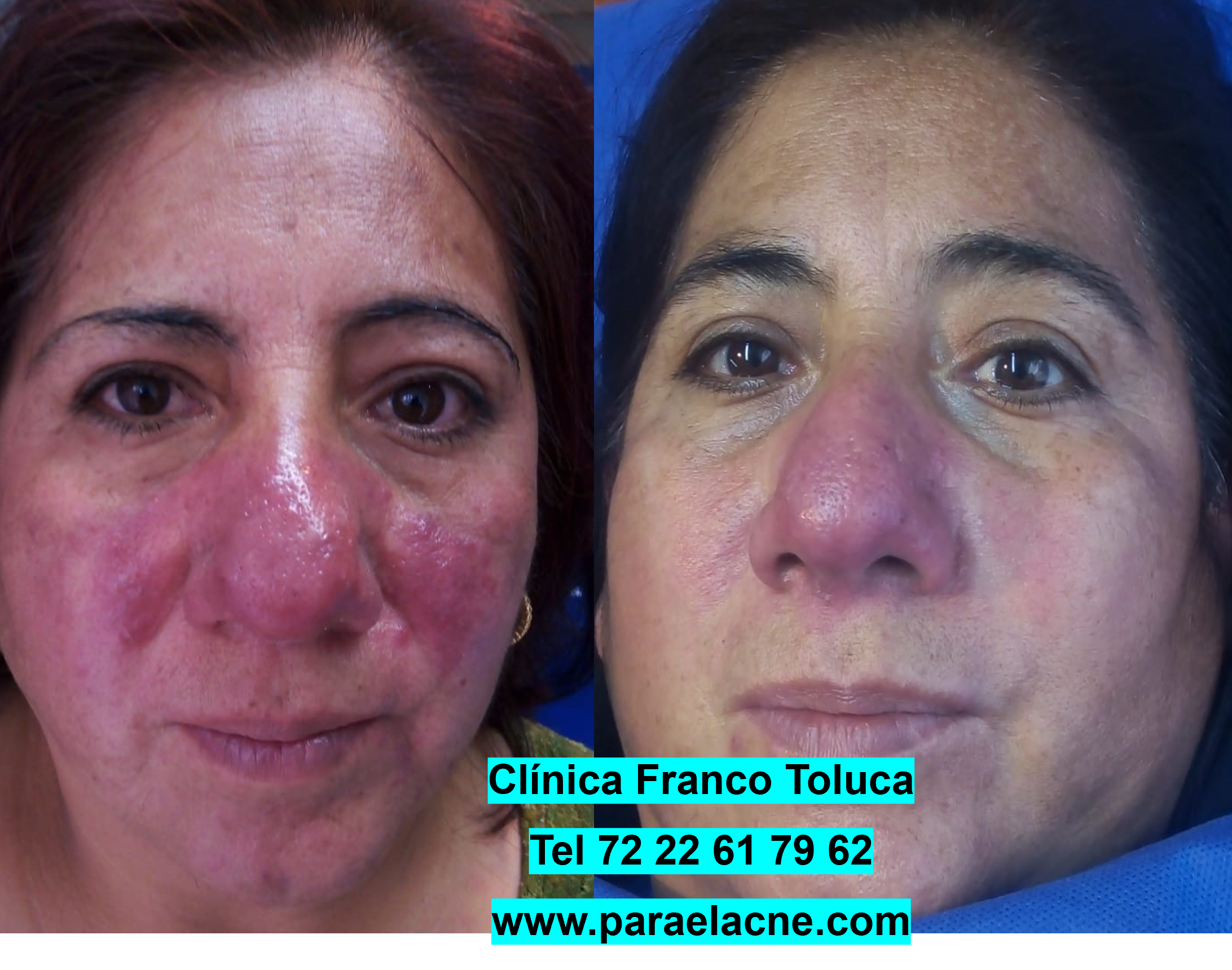 Resultado de tratamiento para  acné en Metepec